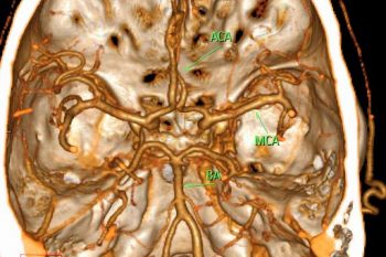 COW Angiography