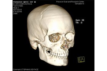 CT 3D Head