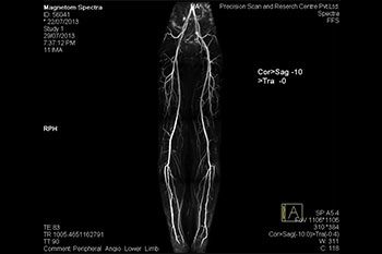 MRI Non-Contrast Angio