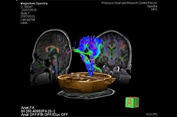 MRI Tractography