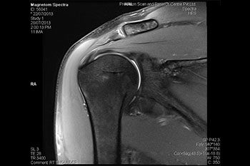 MRI Shoulder