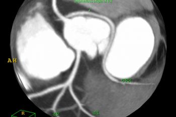 Coronary Anomaly
