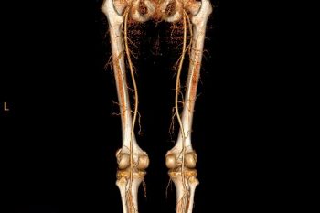 Peripheral Angio
