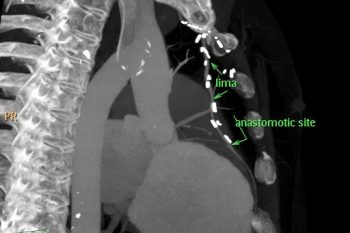Post cabg Vessel Evaluation