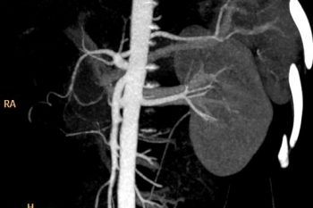 Renal Angiography