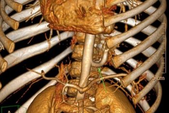 Vessel Supplying Lung Sequestration