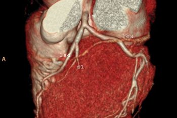 VR Coronary